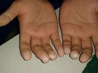水源性肢端角化病手指指尖變白圖 水源性肢端角化病手指指尖變白圖