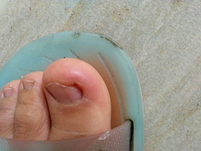 嵌甲大腳趾紅腫發亮圖 嵌甲大腳趾紅腫發亮圖