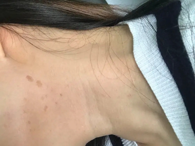 網狀肢端色素沉著脖子上有褐斑圖