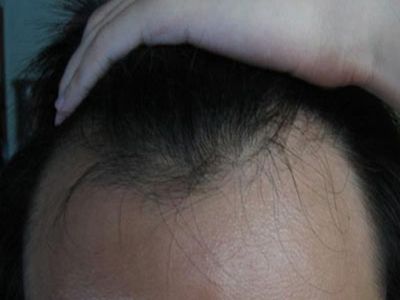 男性型脫髮額頭兩邊出現脫髮圖