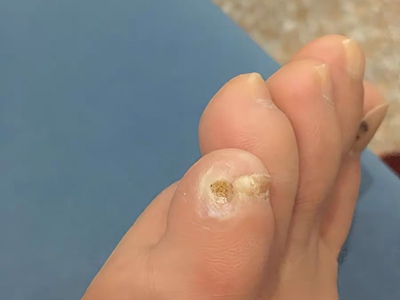 胼胝小腳趾頭有個黃色硬塊周圍發白圖 胼胝小腳趾頭有個黃色硬塊周圍發白圖