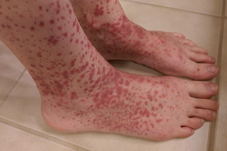 小兒過敏性紫癜腳背有密集紅斑圖