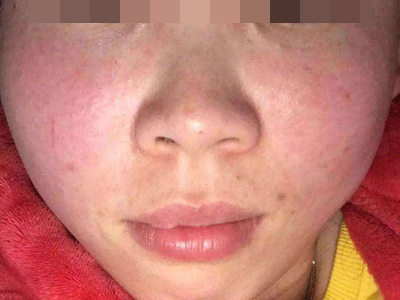 糖皮質激素性紅斑面部大片潮紅斑片圖 糖皮質激素性紅斑面部大片潮紅斑片圖