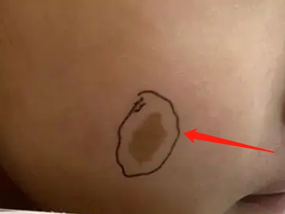 咖啡斑臉上有一處明顯的深咖色斑圖 咖啡斑臉上有一處明顯的深咖色斑圖