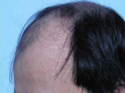 男性型脫髮頭髮大片脫髮圖 男性型脫髮頭髮大片脫髮圖