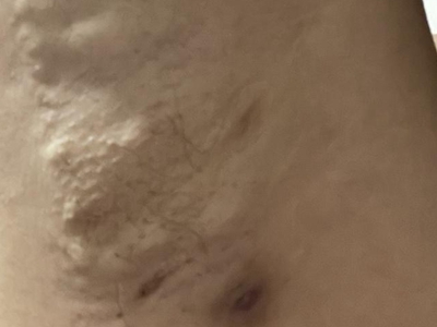 皮脂腺囊腫腋下突起好多包圖