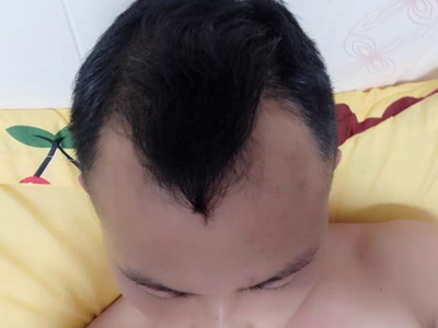 雄激素性脫髮額部兩側頭髮脫沒了圖 雄激素性脫髮額部兩側頭髮脫沒了圖