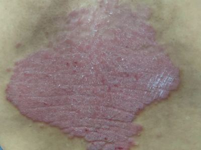 尋常型銀屑病後背有大面積紅斑隆起圖