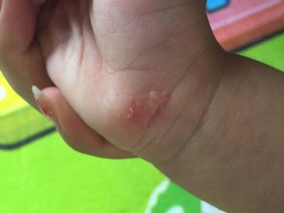 手部濕疹手掌根部起水皰皮膚發紅圖 手部濕疹手掌根部起水皰皮膚發紅圖