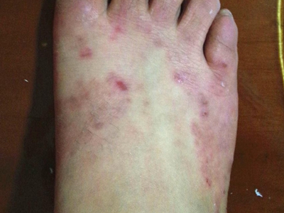 色素性痒疹腳背丘疹破損結痂圖