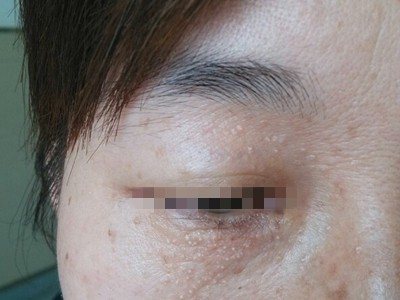 原發性粟丘疹眼周有一圈白丘疹圖 原發性粟丘疹眼周有一圈白丘疹圖