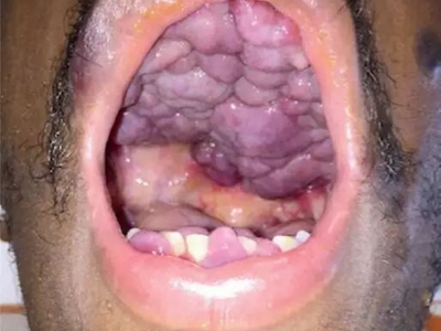 愛滋病皮膚腫瘤口腔有多個紫色結節圖