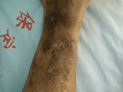 煙酸缺乏症小腿皮膚粗糙長黑斑圖 煙酸缺乏症小腿皮膚粗糙長黑斑圖