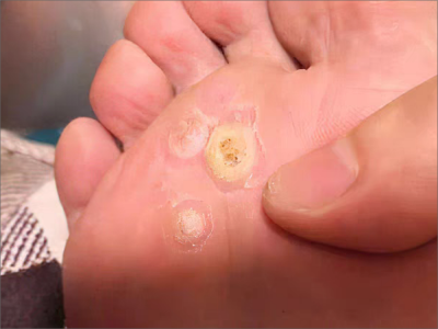 胼胝腳底有三個圓形硬塊脫皮圖 胼胝腳底有三個圓形硬塊脫皮圖