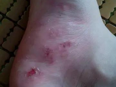 著色真菌病腳部破潰糜爛圖 著色真菌病腳部破潰糜爛圖