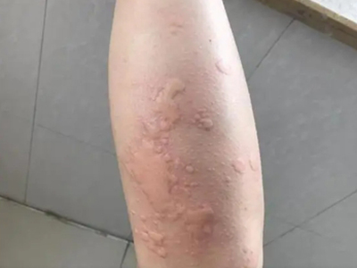 蠓蟲叮咬小腿上有風團圖 蠓蟲叮咬小腿上有風團圖
