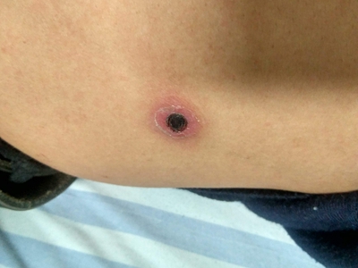 恙蟲病腰部圓形黑色焦痂圖 恙蟲病腰部圓形黑色焦痂圖