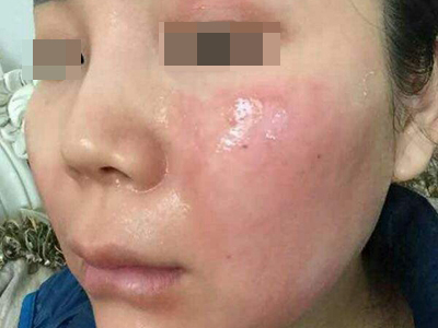 糖皮質激素性紅斑面部有淺紅色斑塊圖