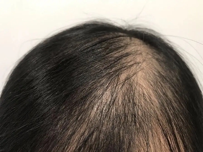 雄激素性脫髮頭頂的頭髮逐漸減少圖