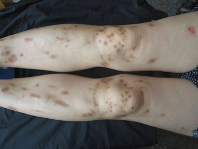 色素性痒疹腿上有一塊塊的褐色斑點圖