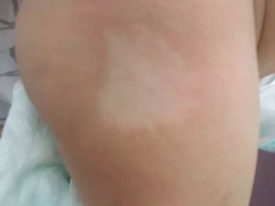 脫色素性痣大腿上有白斑圖