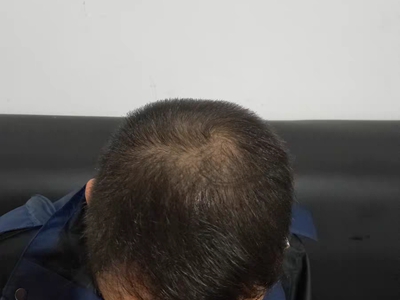 雄激素性脫髮頭頂部頭髮變少圖 雄激素性脫髮頭頂部頭髮變少圖