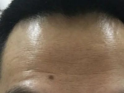 良性幼年黑素瘤額頭上有黑痣圖