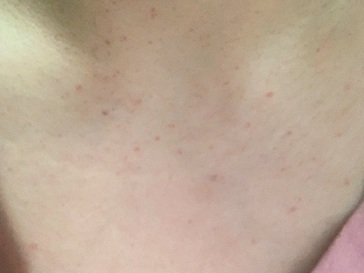 血管內壓力增多性紫癜胸前紅點點圖