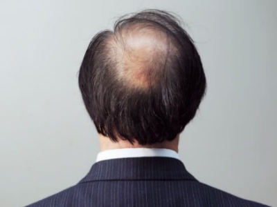 男性型脫髮頭頂禿了一大塊圖