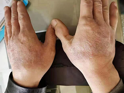 手部濕疹雙手手背皮膚有色素沉著圖 手部濕疹雙手手背皮膚有色素沉著圖