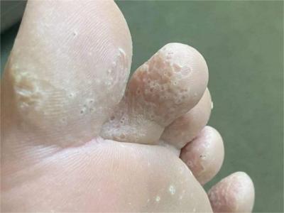 溝狀跖部角質松解症腳趾有很多小坑圖 溝狀跖部角質松解症腳趾有很多小坑圖