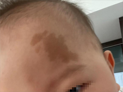 咖啡斑額頭上有不規則的深咖色斑圖 咖啡斑額頭上有不規則的深咖色斑圖