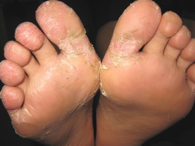 幼年跖部皮病腳底有裂紋脫屑圖