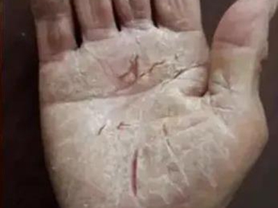 手足皸裂手掌發乾有裂口圖
