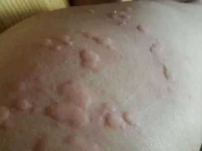 海鮮過敏大腿好幾片凸起的風團圖 海鮮過敏大腿好幾片凸起的風團圖