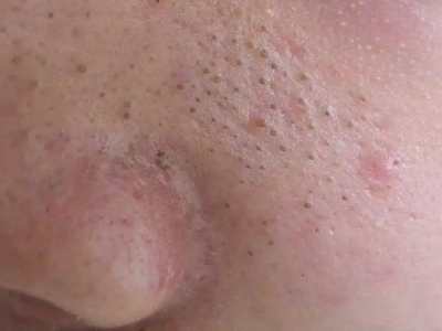 小棘毛壅病面部有黑色突起丘疹圖