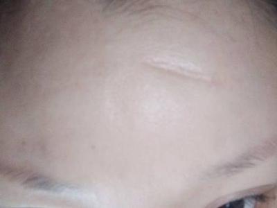 萎縮性瘢痕前額一條凹進去的瘢痕圖