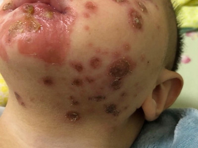 新生兒膿皰瘡面部許多水皰破潰結痂圖 新生兒膿皰瘡面部許多水皰破潰結痂圖