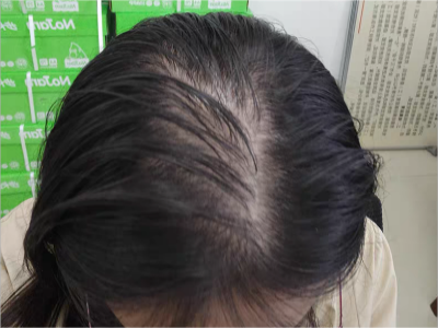 雄激素性脫髮頭頂毛髮稀疏油膩圖 雄激素性脫髮頭頂毛髮稀疏油膩圖
