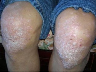 關節病型銀屑病膝蓋大片白色脫屑圖 關節病型銀屑病膝蓋大片白色脫屑圖