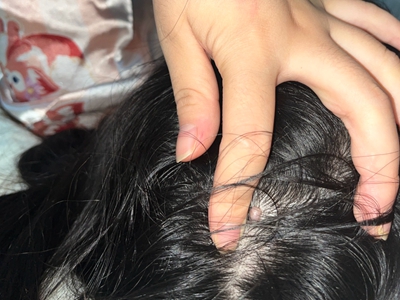 皮膚纖維瘤頭皮上有一個小肉球圖