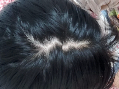雄激素性脫髮頭髮稀疏露頭皮圖 雄激素性脫髮頭髮稀疏露頭皮圖