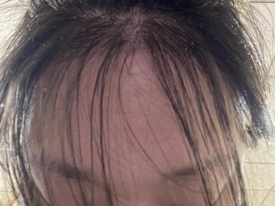 女性型脫髮前額頭髮稀少圖