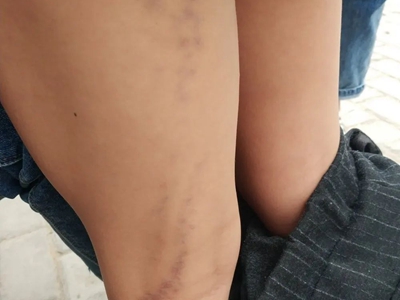 線狀苔蘚腿上有棕色疹子圖
