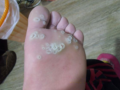 溝狀跖部角質松解症腳底發白有坑圖 溝狀跖部角質松解症腳底發白有坑圖