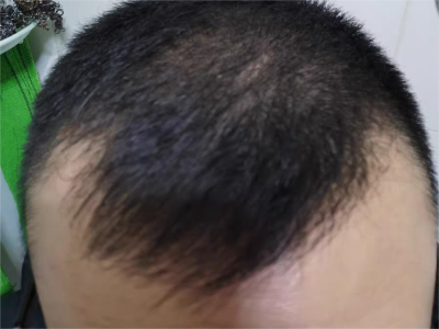 雄激素性脫髮雙側額角的頭髮禿了圖 雄激素性脫髮雙側額角的頭髮禿了圖