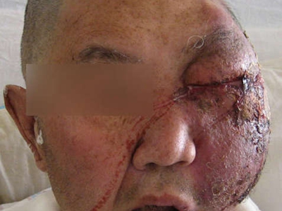 嗜酸性蜂窩織炎面部腫了半邊圖