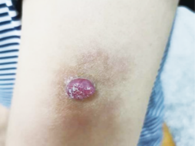 結節型黑色素瘤胳膊上長紅色結節圖