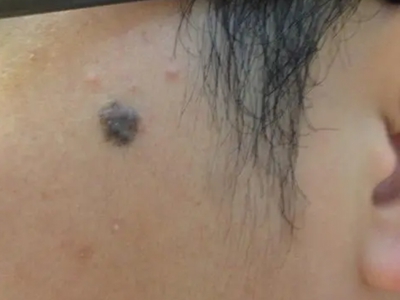 良性幼年黑素瘤臉上黑痣圖 良性幼年黑素瘤臉上黑痣圖