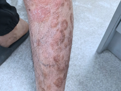 尋常型銀屑病小腿有相互融合的斑塊圖